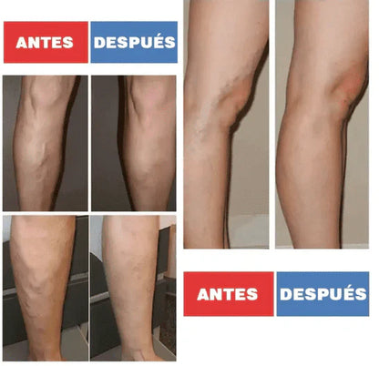 VariPret™ - Parches para Tratamiento de Varices - ¡Dile adiós al dolor en tus piernas! 🦵